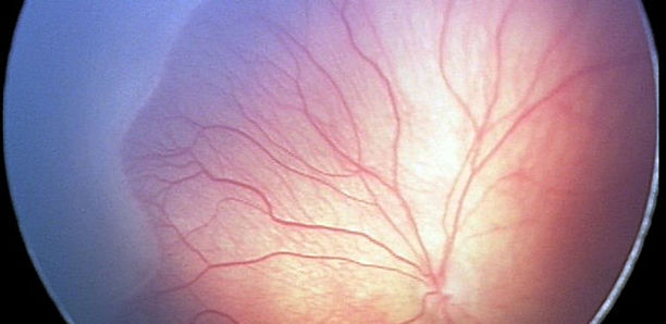 Bild zu Sehstörungen - Frühgeborenenretinopathie (ROP) – was gilt es zu beachten?