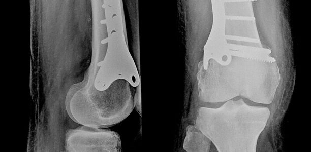 Bild zu Der diagnostische Blick - 6-jähriges Mädchen mit X-Bein-Fehlstellung