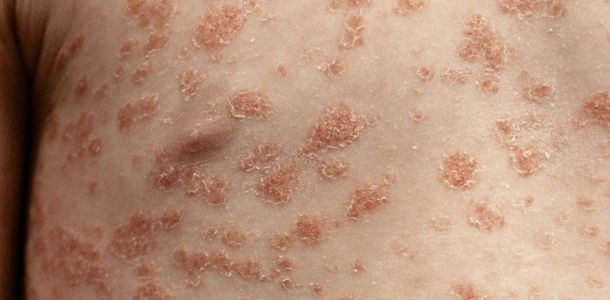 Bild zu Hauterkrankungen - Psoriasis im Kindesalter