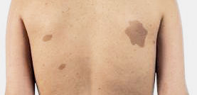Bild: Gerhard Kurlemann Bild zu Neurokutane Syndrome - Neurofibromatose Typ 1 und Typ 2