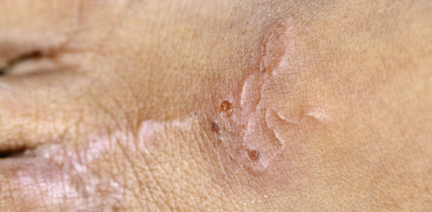 Bild: Hermann Feldmeier Bild zu Parasitosen - Kutane Larva migrans und Tungiasis