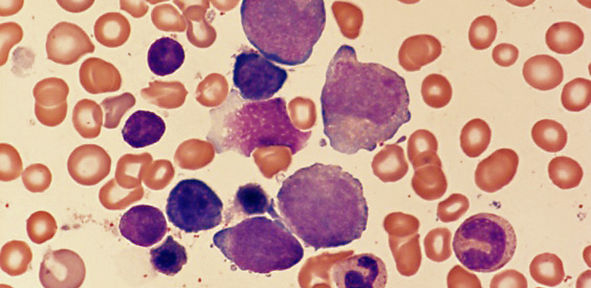 Bild zu Frühdiagnostik von Tumoren - Denkaufgaben der pädiatrischen Hämato-Onkologie