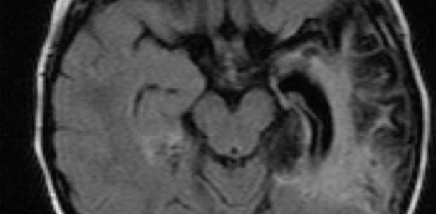 Bild zu Seltene Erkrankungen - NMDA-Rezeptor-Enzephalitis