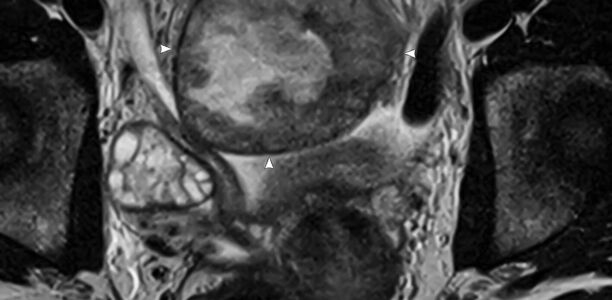 Bild zu Der diagnostische Blick - 15-jähriges Mädchen mit subakuten Bauchschmerzen und erhöhten Infektzeichen