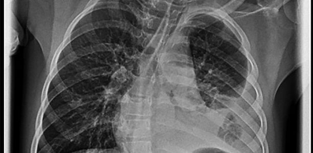 Bild zu 3 Fälle aus der Praxis - Respiratorische Infektionen
