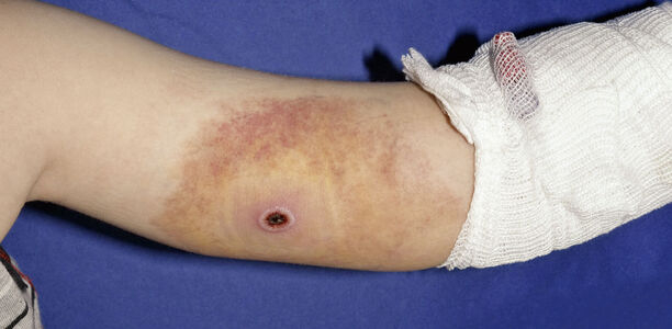Bild zu Der diagnostische Blick - Ein 8-jähriger Junge mit kreisrunder Hautnekrose am linken Oberarm