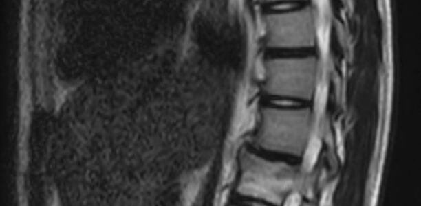 Bild: Clemens Freiberg Bild zu Der diagnostische Blick - Ein 16-jähriges Mädchen mit Rückenschmerzen und Kyphose
