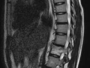 Bild zu Der diagnostische Blick - Ein 16-jähriges Mädchen mit Rückenschmerzen und Kyphose