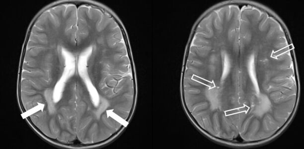 Bild zu Der diagnostische Blick - Ein 2-jähriger Junge mit Makrozephalie und Leukenzephalopathie