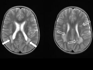 Bild zu Der diagnostische Blick - Ein 2-jähriger Junge mit Makrozephalie und Leukenzephalopathie