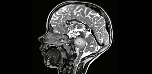 Bild: C. M. Kramm Bild zu Hirntumore im Kindes- und Jugendalter - Teil 1: Allgemeine Pädiatrische Neuroonkologie