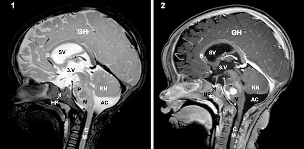 Bild zu Hirntumore im Kindes- und Jugendalter - Teil 2: Spezielle Pädiatrische Neuroonkologie