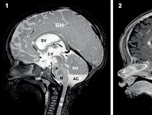 Bild zu Hirntumore im Kindes- und Jugendalter - Teil 2: Spezielle Pädiatrische Neuroonkologie