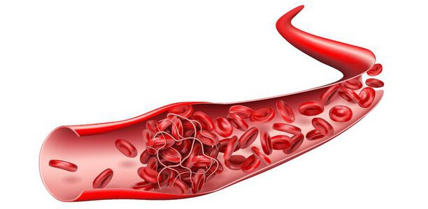 Bild zu COVID-19 - Nicht nur an akute Inflammation denken: Thromboembolien Monate nach einer COVID-19-Infektion!