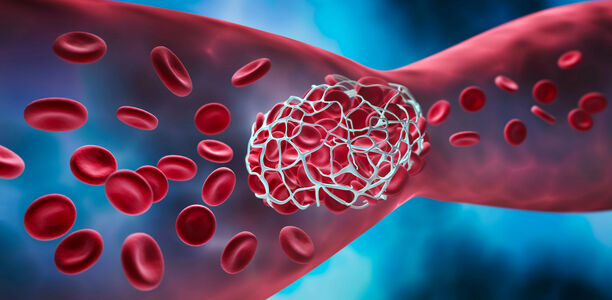 Bild: peterschreiber.media - stock.adobe.com Bild zu Erste Erfahrungen mit Rivaroxaban - Therapie und Sekundärprophylaxe von Thrombosen im Kindes- und Jugendalter