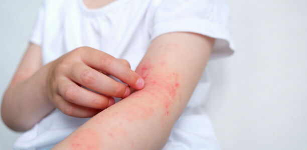 Bild: Марина Терехова - stock.adobe.com Bild zu Fragen aus der Praxis - Atopische Dermatitis