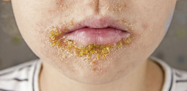 Bild: FotoHelin - stock.adobe.com Bild zu Antibiotika-Serie der YoungDGPI - Ambulante Therapie der Impetigo contagiosa