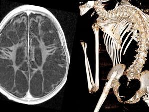 Bild zu Schwere zerebrale Schädigung - Therapiezieländerung und Therapiebegrenzung