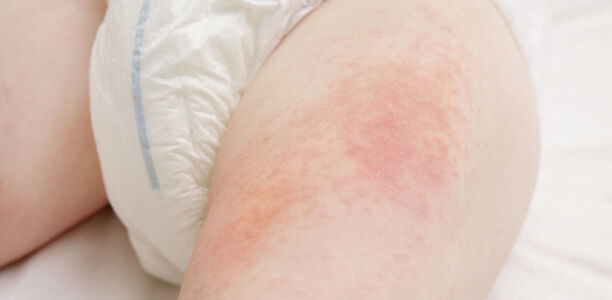 Bild zu KKJ 2025 - Allergie bei Kindern: bessere Früherkennung durch Screening überfällig