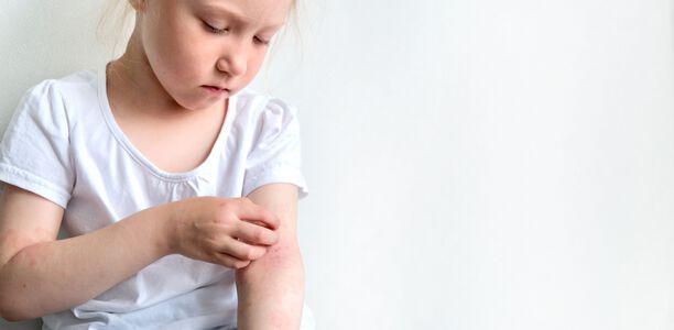 Bild zu Atopischer Dermatitis - Häufigkeit des Badens nicht entscheidend