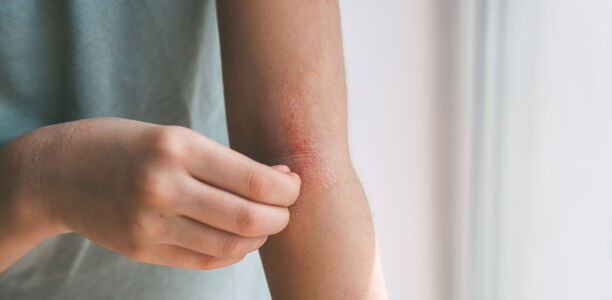 Bild zu Atopische Dermatitis - Welche Faktoren bestimmen Remission oder Persistenz im Erwachsenenalter?