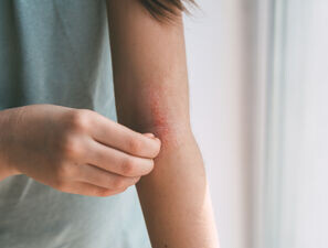 Bild zu Atopische Dermatitis - Welche Faktoren bestimmen Remission oder Persistenz im Alter?