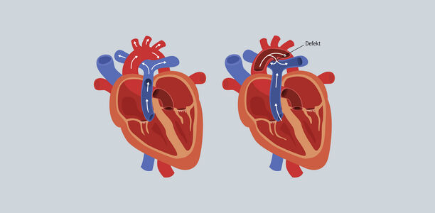 Bild zu Offener Ductus arteriosus - Aktive vs. abwartende Behandlung bei Frühgeborenen