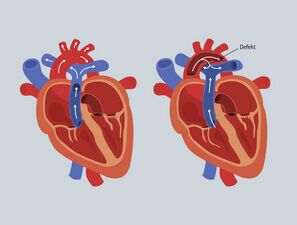 Bild zu Offener Ductus arteriosus - Aktive vs. abwartende Behandlung bei Frühgeborenen