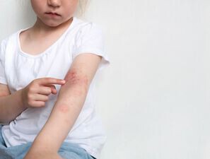 Bild zu Atopische Dermatitis - Nicht nur die Haut, auch die Psyche leidet