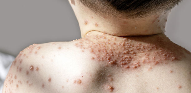 Bild zu Impfprävention-Serie der YoungDGPI - Varizellen und Zoster