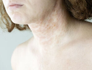 Bild zu Atopische Dermatitis - Betroffene Jugendliche sind seelisch stark belastet