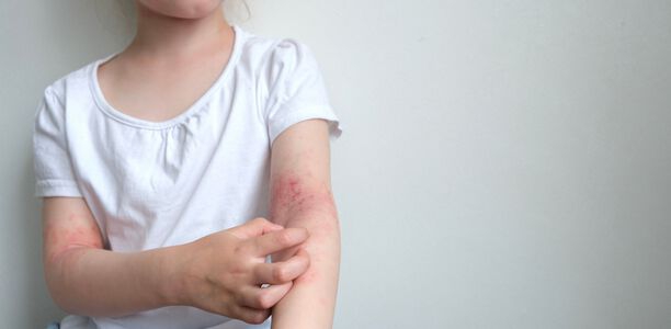 Bild zu Atopische Dermatitis - Drei Fragen aus der Praxis