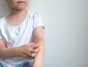 Bild zu Atopische Dermatitis - Drei Fragen aus der Praxis